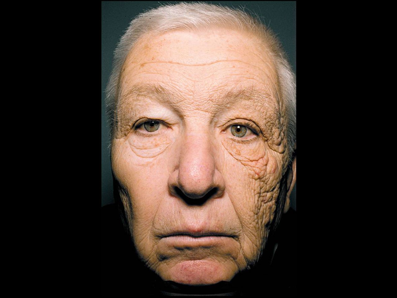 Skin ageing due to UV damage